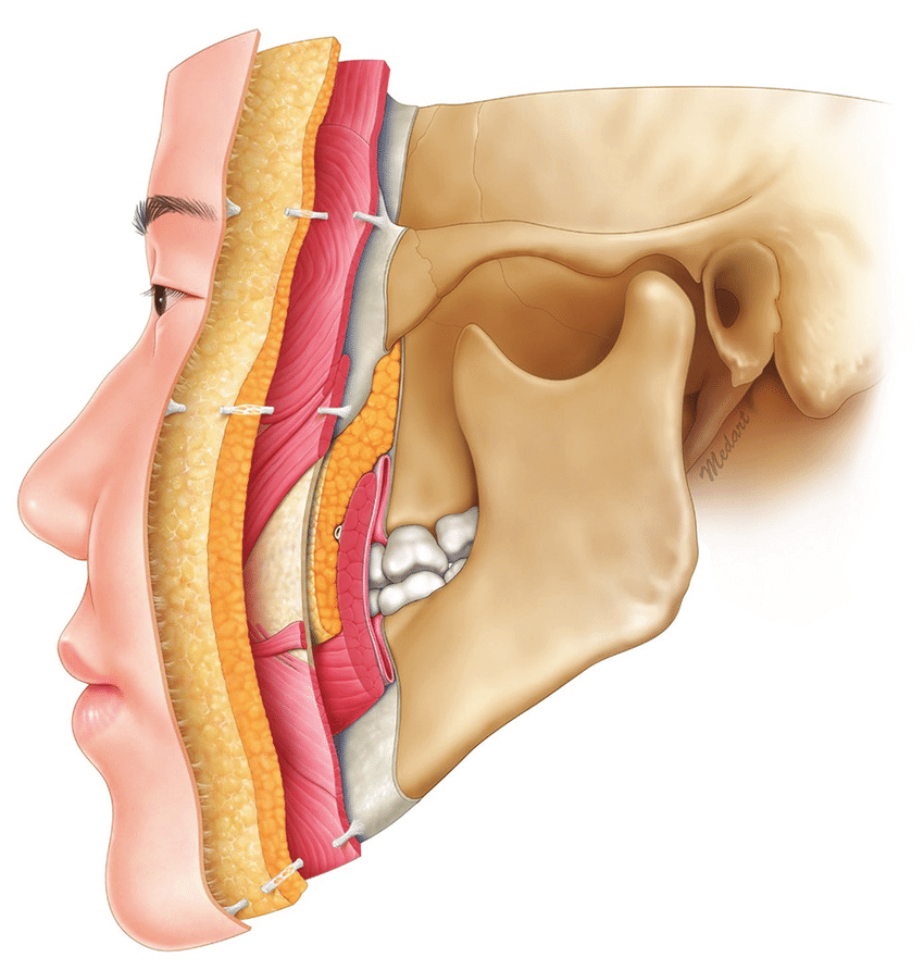 A cross-section of the five layers of facial tissue, highlighting the SMAS layer.