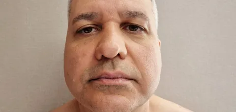 Frontal view of man before tipplasty in Turkey, showing nasal tip shape before cosmetic nasal tip refinement surgery.