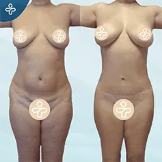 tummy-tuck-revision