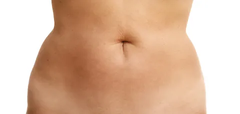 Close-up of abdomen with excess skin and fat before tummy tuck revision surgery in Turkey