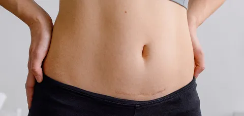 Close-up of lower abdomen showing healed scar after tummy tuck surgery in Turkey