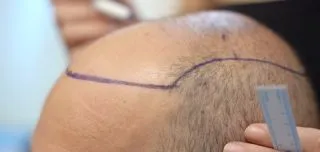 Close-up of male scalp with hairline design drawn before hair transplant in Turkey, showing early stage of hair loss