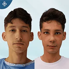 ultrasonic-rhinoplasty