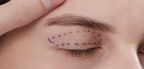 Close-up of upper eyelid with surgical markings before blepharoplasty procedure in Turkey