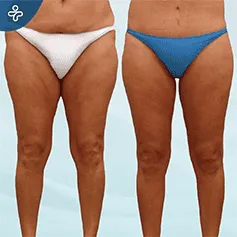 vertical-thigh-lift-(1)