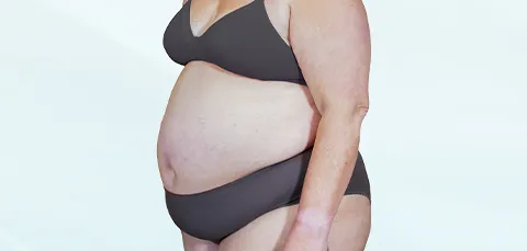 Side profile of woman before weight loss surgery showing abdominal fat and body contour
