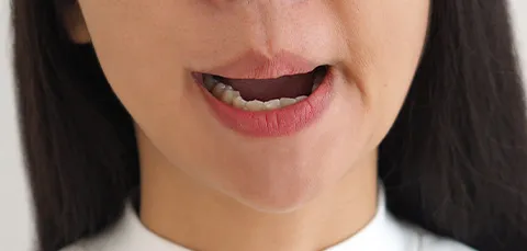 A close-up of a womans mouth asymmetrically opening, demonstrating recurrent facial palsy