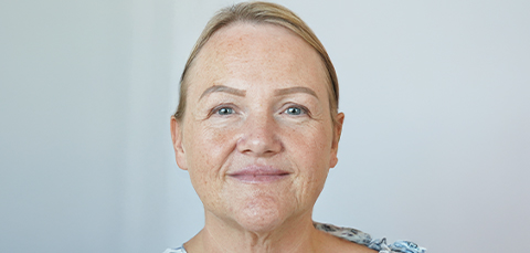 Middle-aged woman in early recovery phase after facelift surgery, showing natural facial expression