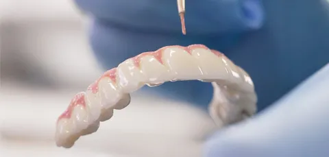 Close-up of zygomatic dental implants in Turkey, showing detailed dental prosthetic work for advanced tooth restoration.